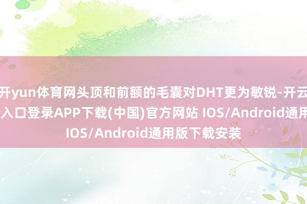 开yun体育网头顶和前额的毛囊对DHT更为敏锐-开云kaiyun登录入口登录APP下载(中国)官方网站 IOS/Android通用版下载安装